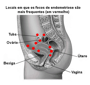 Sente dores fortes no ânus ou reto e não sabe o que é? Pode ser hemorroida,  doença caracterizada - InMeD