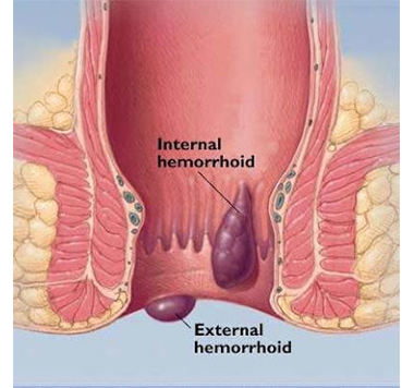 Sente dores fortes no ânus ou reto e não sabe o que é? Pode ser hemorroida,  doença caracterizada - InMeD